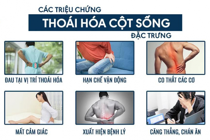 Thoái hóa cột sống gây biến chứng nguy hiểm